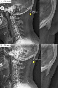 Read more about the article Exostosis: Minden, amit tudni kell erről a jelenségről