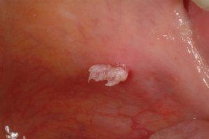 Read more about the article Minden, amit tudni kell az HPV vírusról