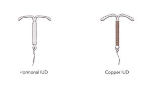 Read more about the article Minden, amit tudni kell az IUD-ról