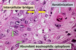 Read more about the article Minden, amit tudnod kell a carcinoma planocellulare-ról