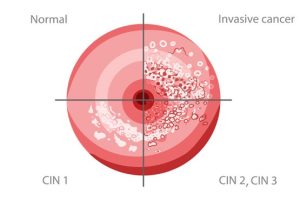 Read more about the article Mindent, amit tudni kell a CIN 1-ről