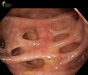 Read more about the article Minden, amit tudni kell a diverticulosis sigmae-ről