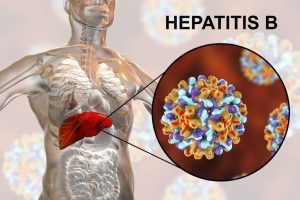 Read more about the article Magas Anti-HBs Szint és a HBV Védettség