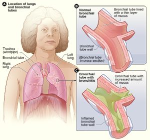 Read more about the article Heveny Bronchitis: Mindent, amit tudni érdemes