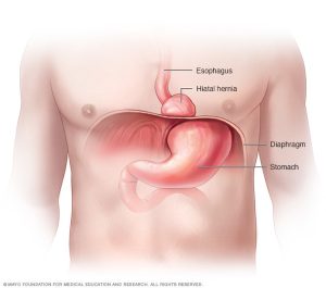 Read more about the article Mindent Ami Tudni Akartál a Hiatus Herniáról