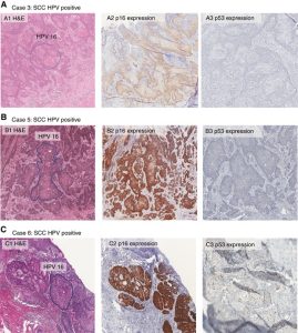 Read more about the article Minden, amit tudni érdemes az HPV 16 pozitív eredményéről