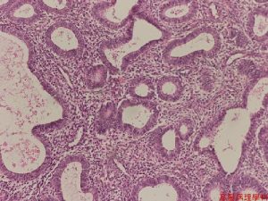 Read more about the article Minden, amit tudni kell a hyperplasia glandularis endometrii-ről