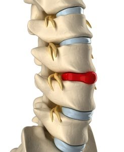 Read more about the article Kisizületi Arthrosis: Mindent, Amit Tudni Kell