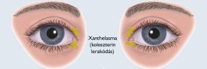 Read more about the article Magas Koleszterinszint: Mindent, amit Tudni kell