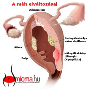 Read more about the article Megvastagodott méhnyálkahártya: Mi is jelent ez pontosan?