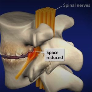 Read more about the article Minden, amit tudni kell a spondylosis lumbalis-ról