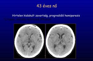 Read more about the article Minden, amit tudni kell a vascularis laesio-ról
